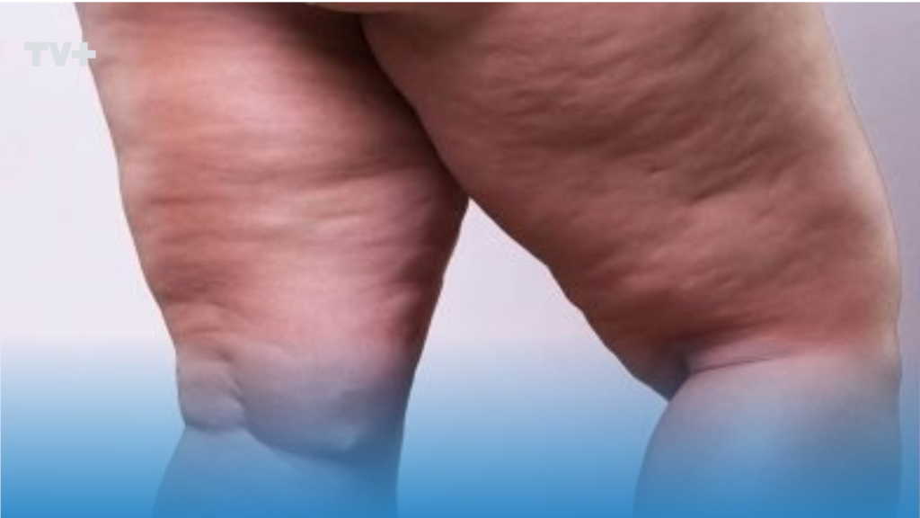 ¿Piernas pesadas y con dolor? Podría ser Lipedema: la enfermedad inflamatoria que afecta a 1 de cada 8 mujeres