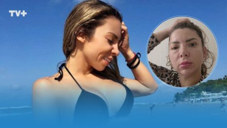 "Ya no aguanto más": Reconocida bailarina expone grave infección tras procedimiento de botox e hilos faciales